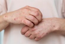 Colombia confirma tres casos de sarampión y refuerza protocolos de vigilancia