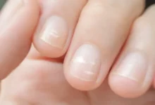 Por qué salen manchas blancas en las uñas y cómo eliminarlas