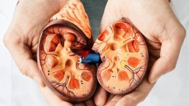 ¿Sufres de cálculos? Expertos advierten sobre las altas probabilidades de volver a padecerlos