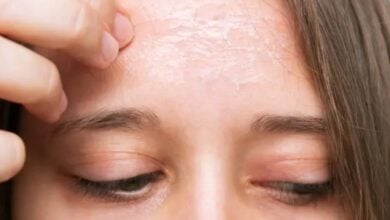 El Espejo del Alma: Por qué tu estrés se convierte en acné o psoriasis