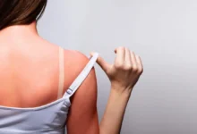 ¿Cómo tratar una quemadura solar? Consejos de expertos para aliviar la piel