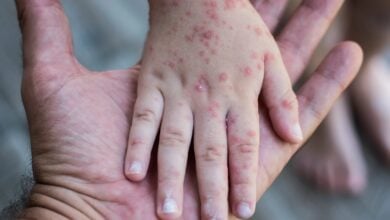 Científicos intentaron ingresar 113 viales con virus de viruela del mono a EE.UU.
