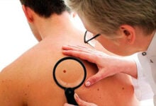 Especialista alerta sobre el incremento de casos de cáncer de piel en Venezuela