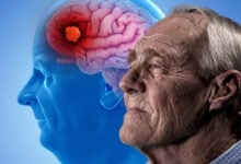 Estudio demuestra que el 60 % de los casos de demencia se pueden prevenir con cambios de hábito