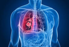 Qué es el adenocarcinoma, el tipo de cáncer que se le extirpó al Papa León XIV