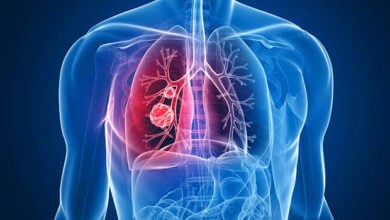Qué es el adenocarcinoma, el tipo de cáncer que se le extirpó al Papa León XIV